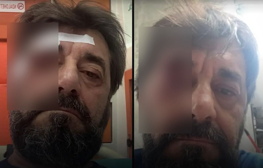ARRESTOHET NJË NGA AUTORËT E DHUNËS NDAJ ANALISTIT ILIR DEMALIA, NJË TJETËR NË KËRKIM